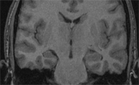 MRI 