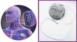 Vagal Nerve Stimulation