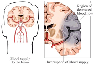 Stroke Diagram