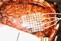 Brainsurgery