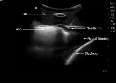 Midscapular screen