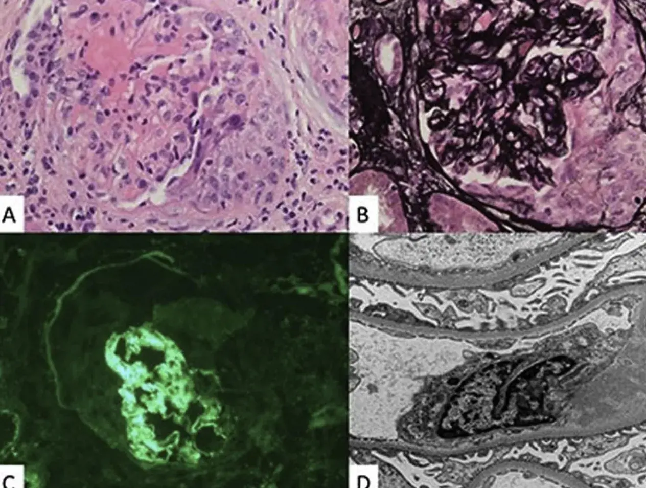 Proliferative glomerulonephritis
