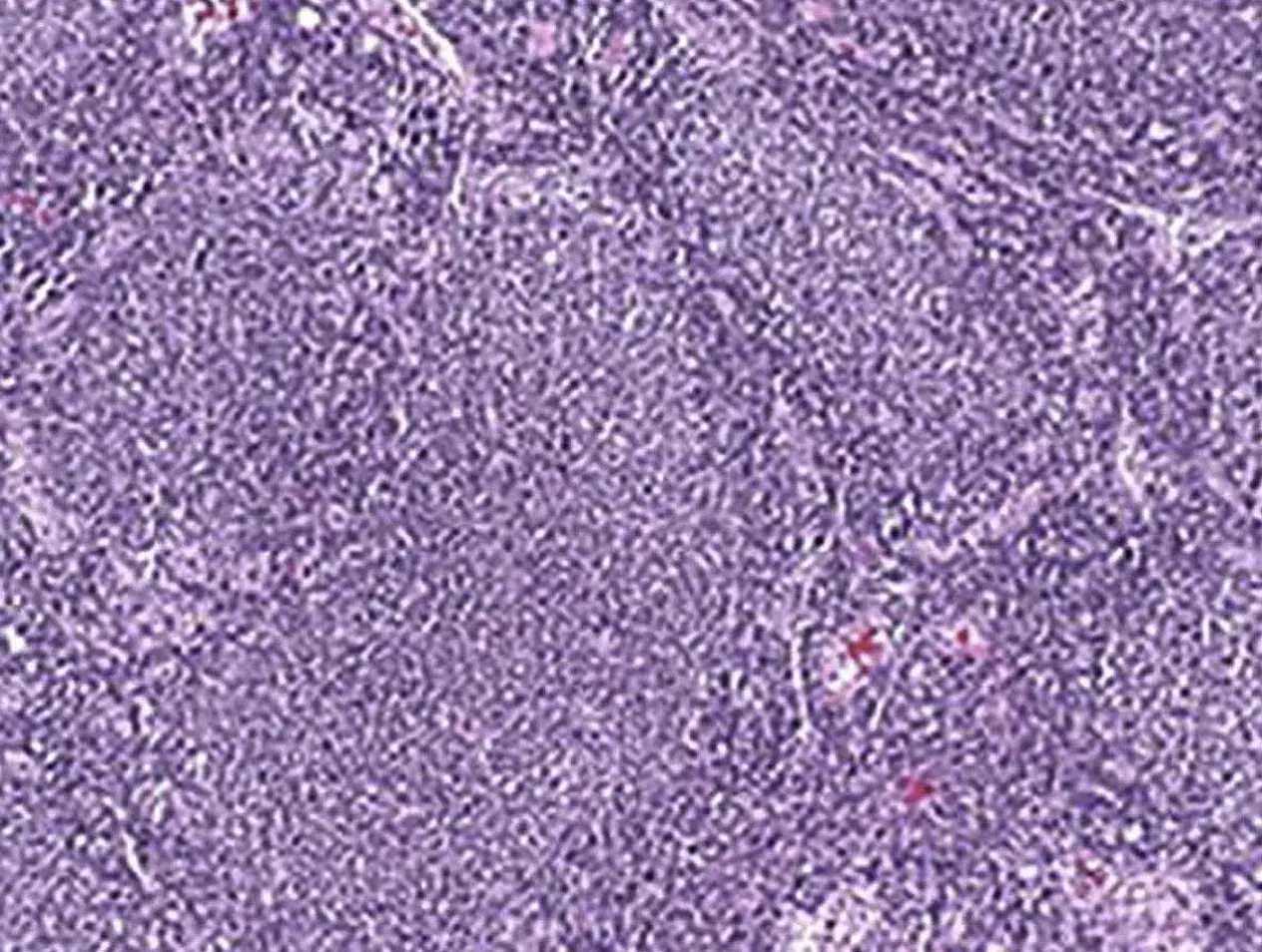 Follicular lymphoma